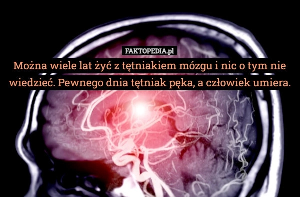Można wiele lat żyć z tętniakiem mózgu i nic o tym nie wiedzieć. Pewnego