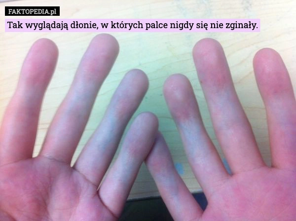 Tak wyglądają dłonie, w których palce nigdy się nie zginały.