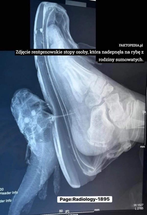 Zdjęcie rentgenowskie stopy osoby, która nadepnęła na rybę z rodziny sumowatych.