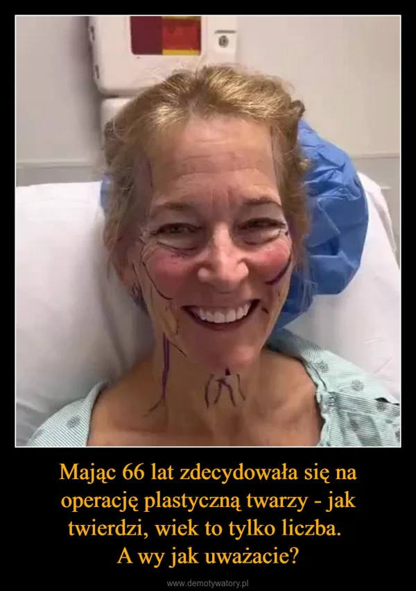 Mając 66 lat zdecydowała się na operację plastyczną twarzy - jak twierdzi, wiek to tylko liczba. A wy jak uważacie?