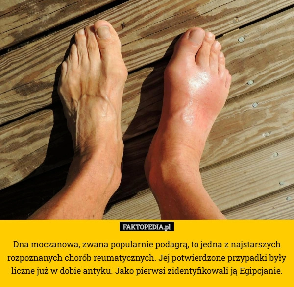 Dna moczanowa, zwana popularnie podagrą, to jedna z najstarszych rozpoznanych