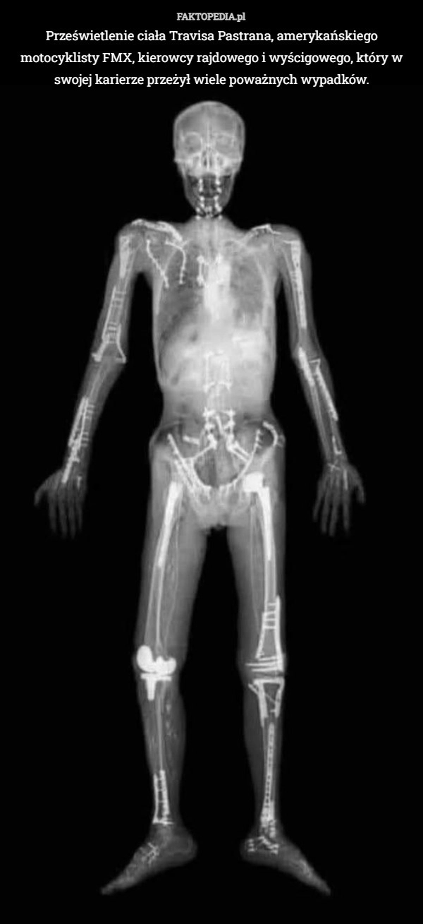 Prześwietlenie ciała Travisa Pastrana, amerykańskiego motocyklisty FMX,